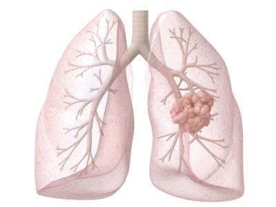 Mesothelioma Treatment